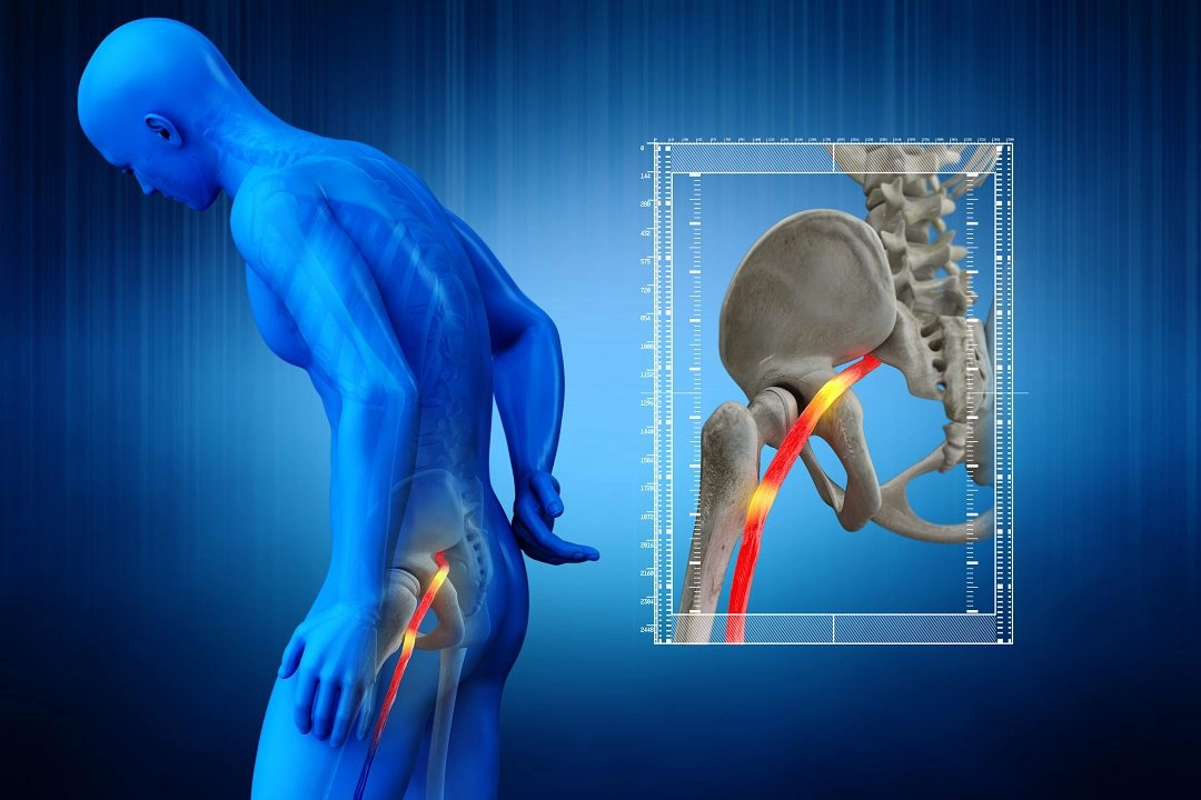 3D sciatic nerve compression diagram